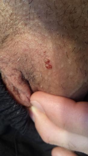 pickel penis.jpg