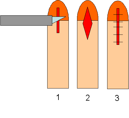 Frenectom%C3%ADa_del_pene.PNG